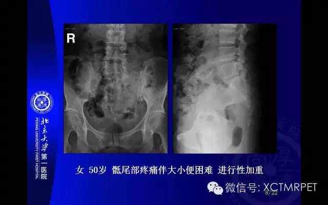 【PPT】脊索瘤