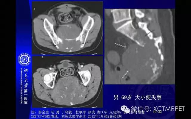 【PPT】脊索瘤