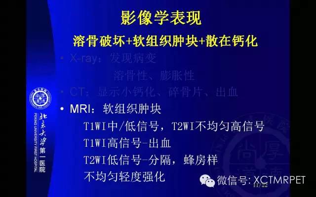【PPT】脊索瘤