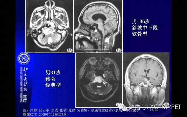 【PPT】脊索瘤