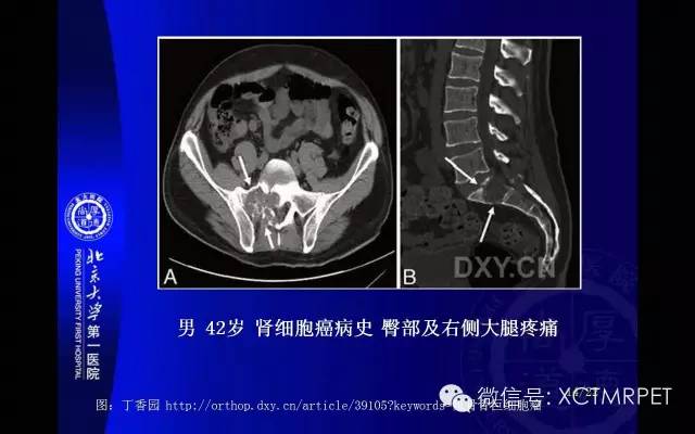 【PPT】脊索瘤