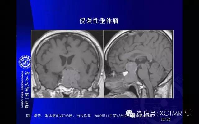 【PPT】脊索瘤