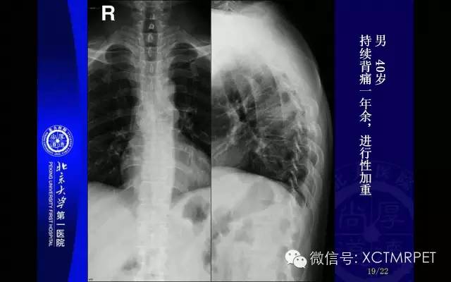 【PPT】脊索瘤