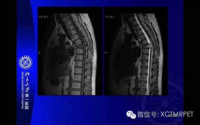 【PPT】脊索瘤