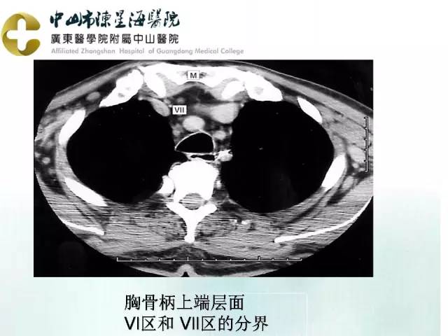 【PPT】甲状腺疾病CT诊断