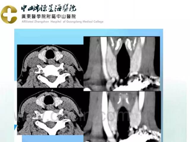 【PPT】甲状腺疾病CT诊断