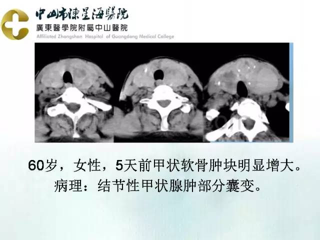 【PPT】甲状腺疾病CT诊断
