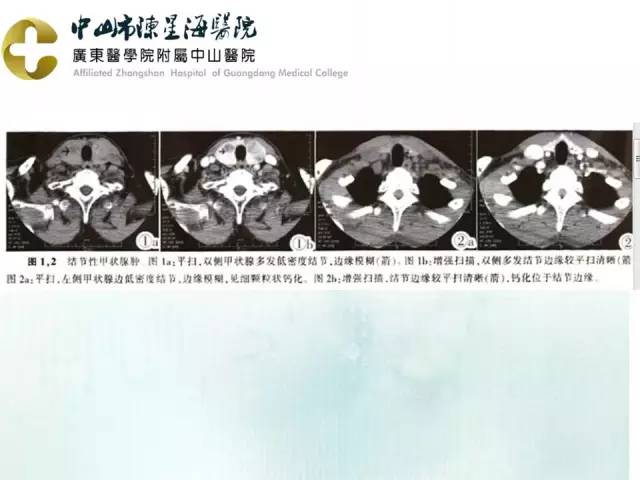 【PPT】甲状腺疾病CT诊断