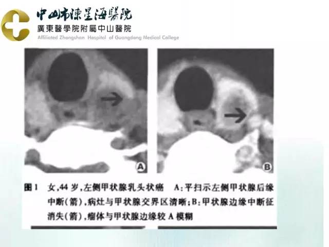 【PPT】甲状腺疾病CT诊断