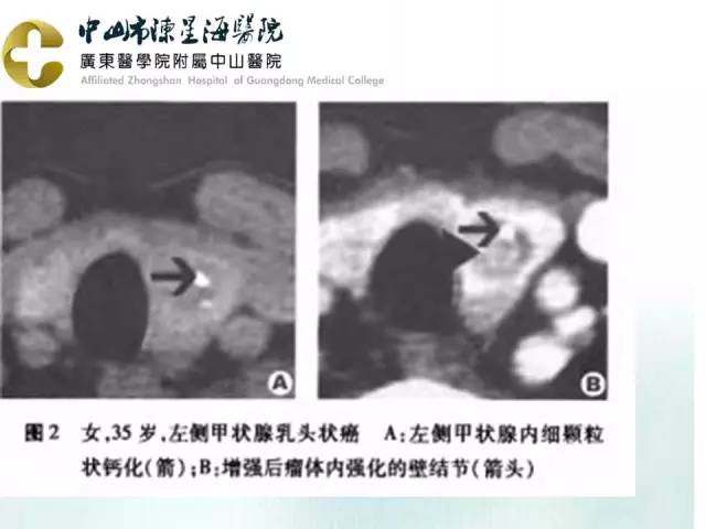 【PPT】甲状腺疾病CT诊断