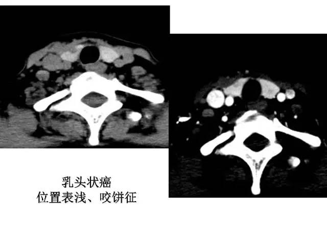 【PPT】甲状腺疾病CT诊断
