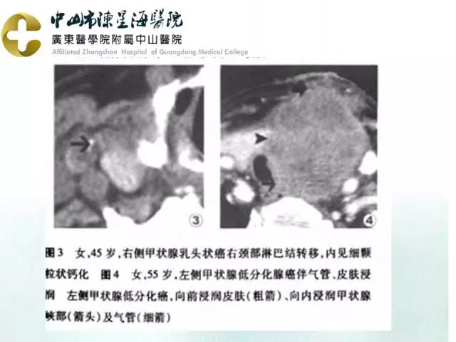【PPT】甲状腺疾病CT诊断