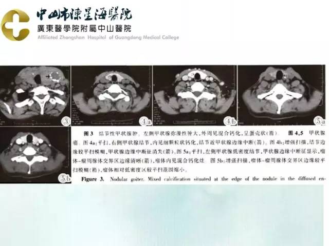 【PPT】甲状腺疾病CT诊断