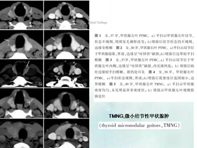 【PPT】甲状腺疾病CT诊断