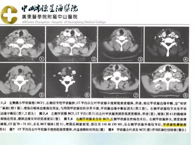 【PPT】甲状腺疾病CT诊断