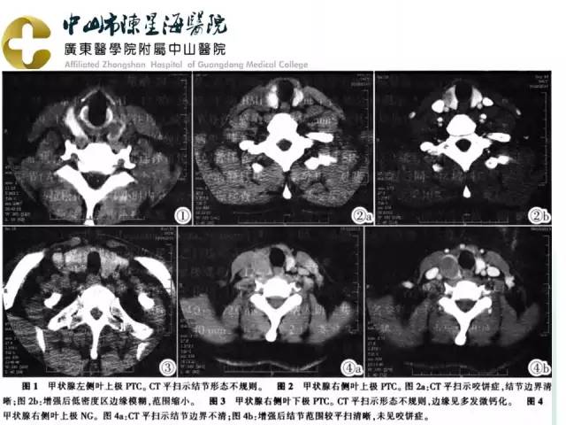 【PPT】甲状腺疾病CT诊断