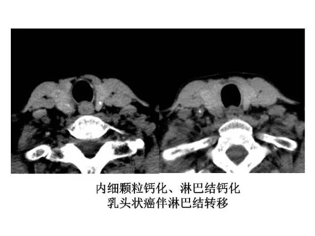 【PPT】甲状腺疾病CT诊断