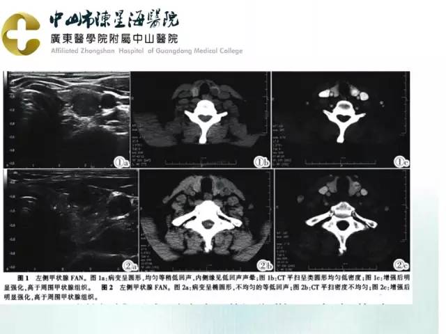 【PPT】甲状腺疾病CT诊断