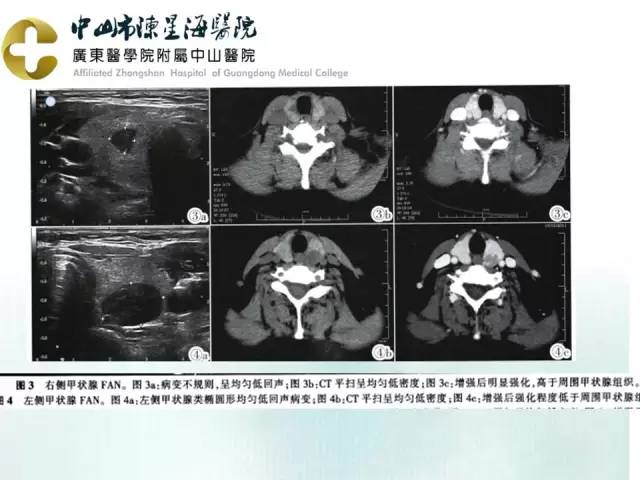 【PPT】甲状腺疾病CT诊断