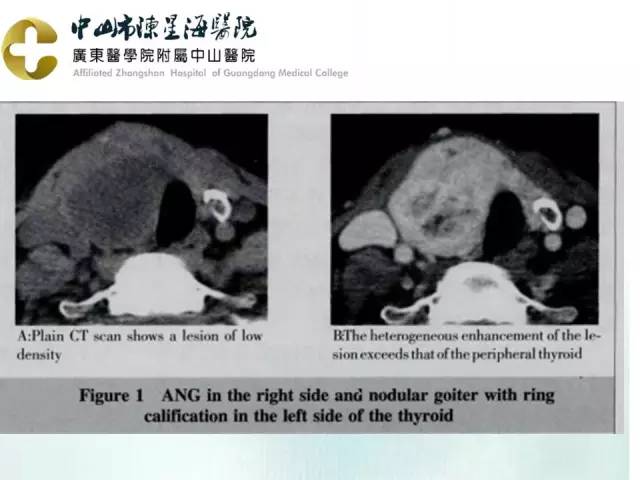 【PPT】甲状腺疾病CT诊断