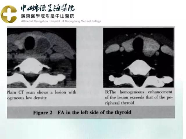 【PPT】甲状腺疾病CT诊断