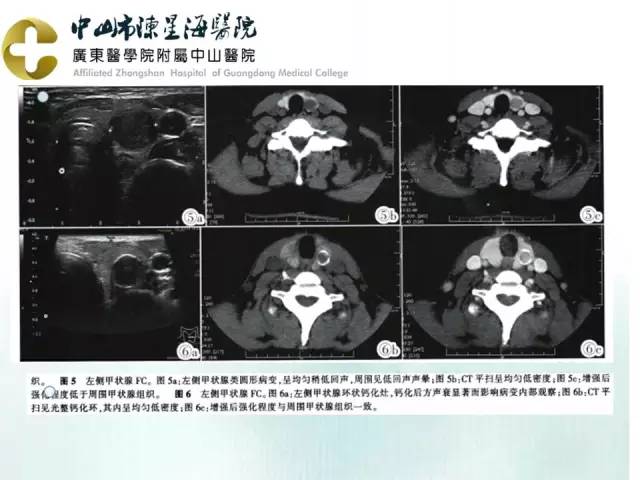 【PPT】甲状腺疾病CT诊断