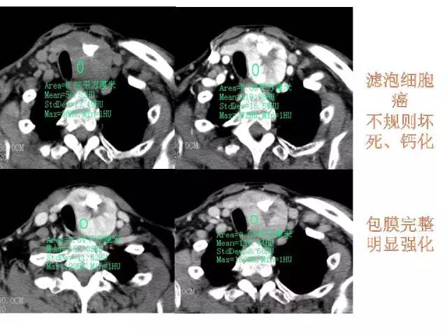 【PPT】甲状腺疾病CT诊断
