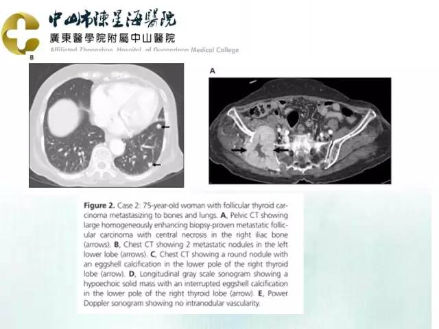 【PPT】甲状腺疾病CT诊断
