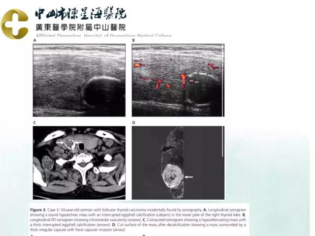【PPT】甲状腺疾病CT诊断