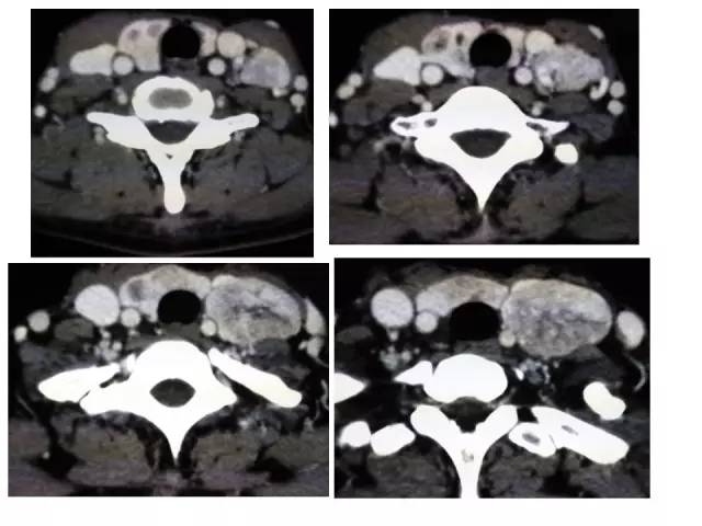 【PPT】甲状腺疾病CT诊断
