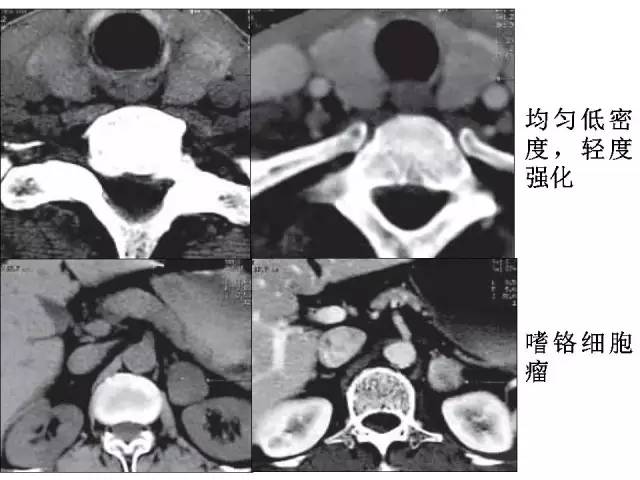 【PPT】甲状腺疾病CT诊断