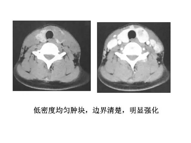 【PPT】甲状腺疾病CT诊断