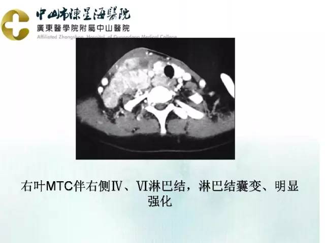【PPT】甲状腺疾病CT诊断