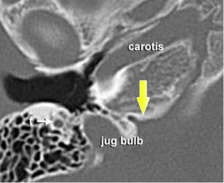 内淋巴囊肿瘤 Endolymphatic Sac Tumors,ELST 内淋巴囊肿瘤 Endolymphatic Sac Tumors,ELST