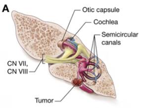 内淋巴囊肿瘤 Endolymphatic Sac Tumors,ELST 内淋巴囊肿瘤 Endolymphatic Sac Tumors,ELST