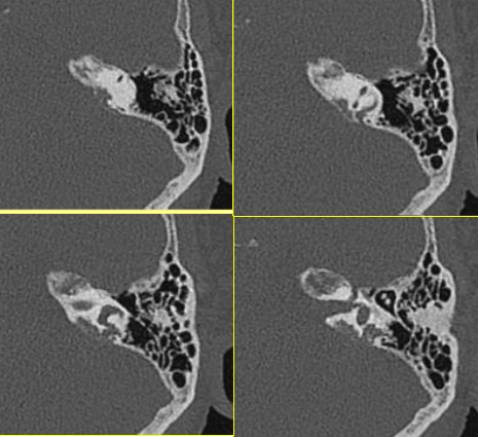 内淋巴囊肿瘤 Endolymphatic Sac Tumors,ELST 内淋巴囊肿瘤 Endolymphatic Sac Tumors,ELST