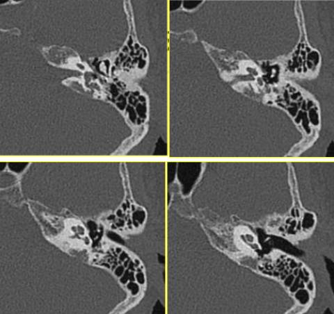 内淋巴囊肿瘤 Endolymphatic Sac Tumors,ELST 内淋巴囊肿瘤 Endolymphatic Sac Tumors,ELST