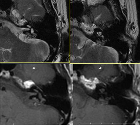 内淋巴囊肿瘤 Endolymphatic Sac Tumors,ELST 内淋巴囊肿瘤 Endolymphatic Sac Tumors,ELST