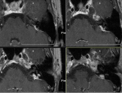 内淋巴囊肿瘤 Endolymphatic Sac Tumors,ELST 内淋巴囊肿瘤 Endolymphatic Sac Tumors,ELST