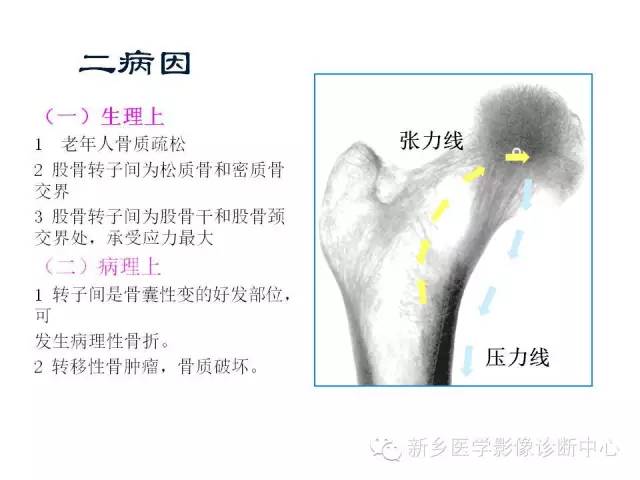 转子间骨折的分型和图解