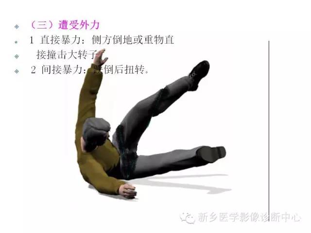 转子间骨折的分型和图解
