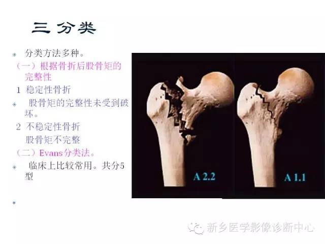 转子间骨折的分型和图解