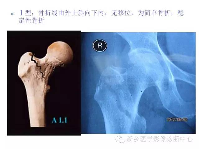 转子间骨折的分型和图解