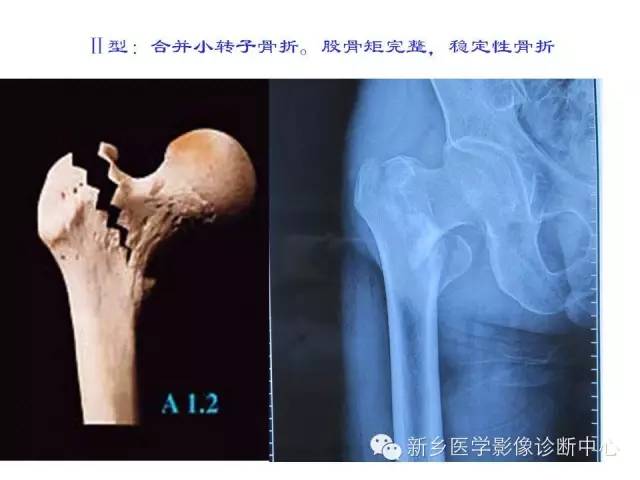 转子间骨折的分型和图解