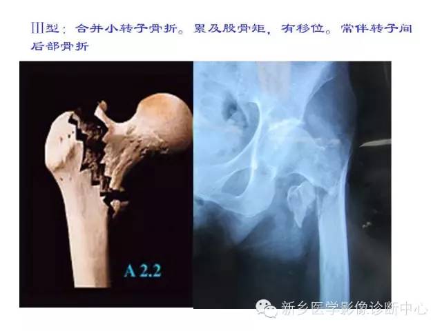 转子间骨折的分型和图解
