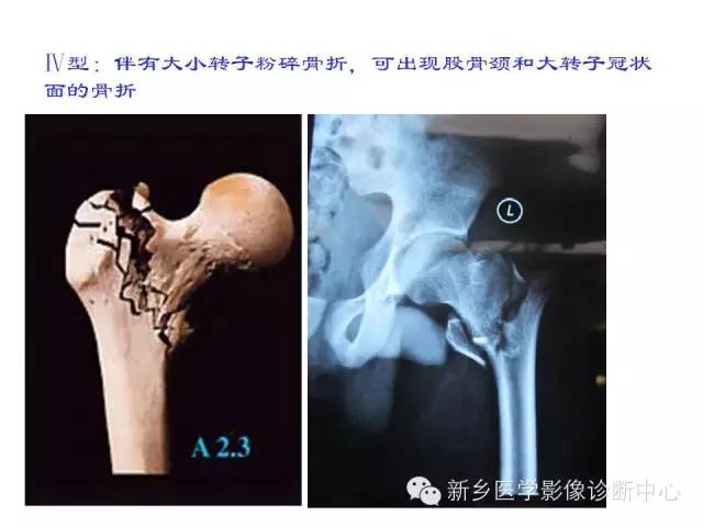 转子间骨折的分型和图解