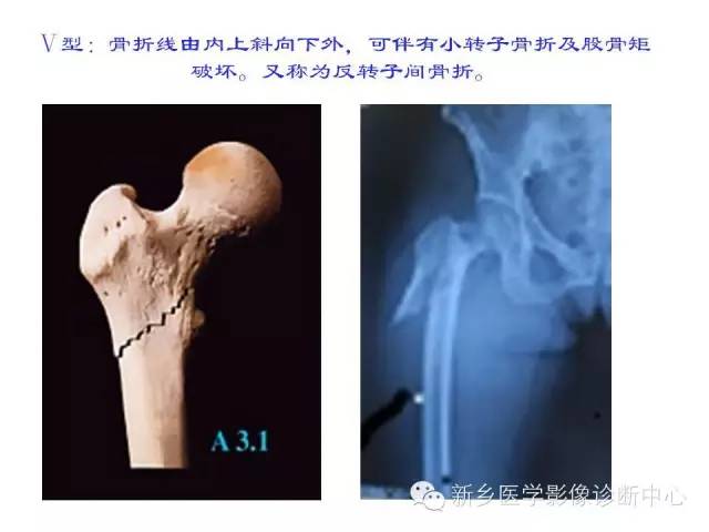 转子间骨折的分型和图解