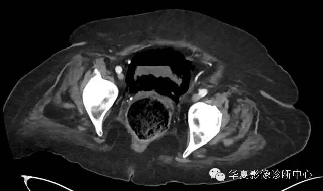【病例】气肿性膀胱炎1例诊断要点