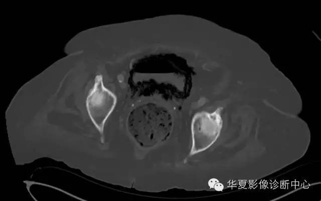 【病例】气肿性膀胱炎1例诊断要点 【病例】气肿性膀胱炎1例诊断要点