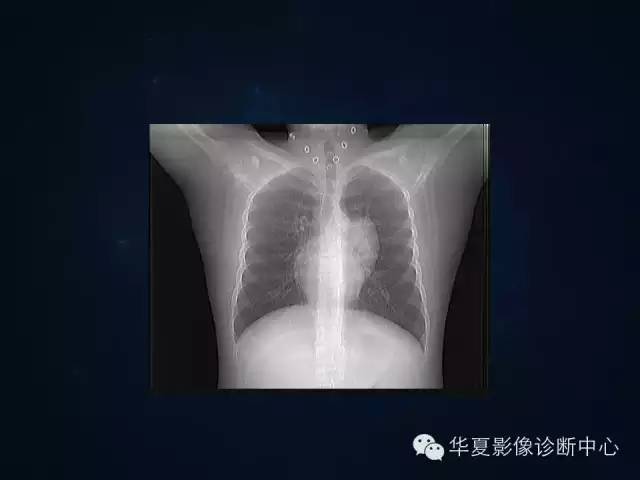 【病例】胸腺囊肿1例CT影像表现与鉴别
